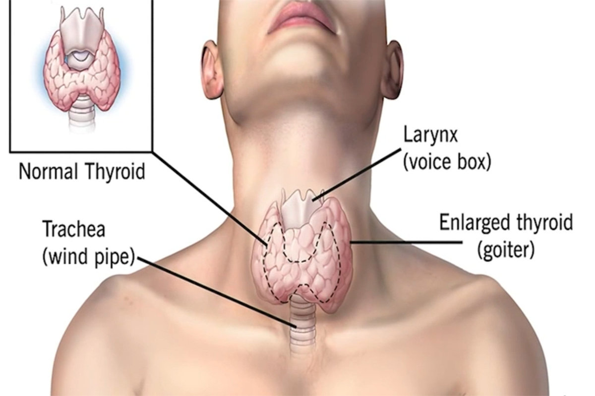 Thyroid